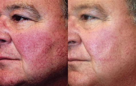 Does Red Light Therapy cause hyperpigmentation? – friendredlight