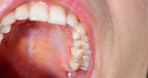 Why Upper Gums Throb - Newbury Park Dentist
