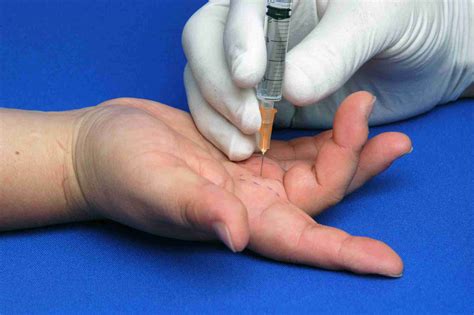 Trigger Finger Injections