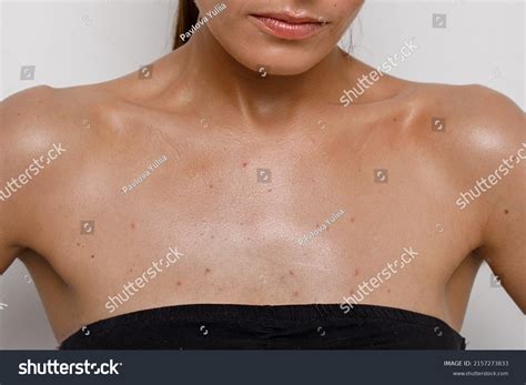 Acne Bumps On Chest