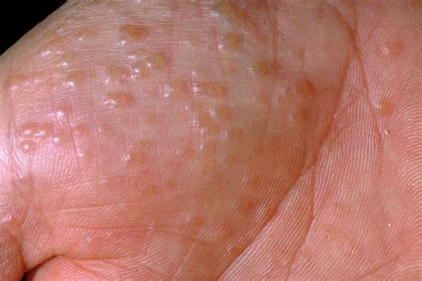 Dermatitis Types and Treatment Options