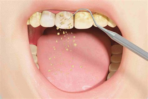 Why Is My Gum Swollen Around One Tooth in the Back?