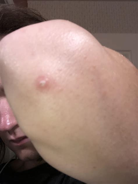 Bump on elbow : r/DermatologyQuestions
