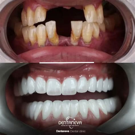 Screwless Dental Implants: 7 Amazing Benefits & Cost