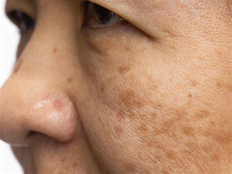 Melasma: ¿en qué consiste y cómo puede prevenirse?