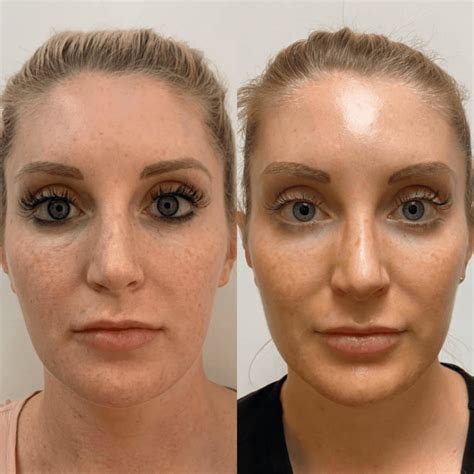 Platelet-Rich Plasma Injection In Montreal