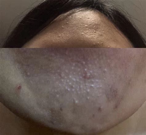 [routine help] How can I get rid of these bumps on my forehead and chin ...