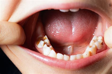 Cavity Tooth Problems: How A Small Hole In Tooth Can Grow Faster Than You Think | Dentalzorg ...