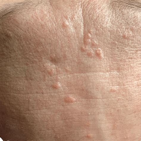 Sebaceous Hyperplasia Treatments Wimbledon & Kensington