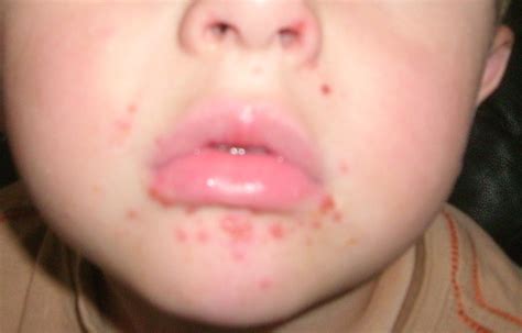 Strep Infection Diaper Rash at Kai Chuter blog