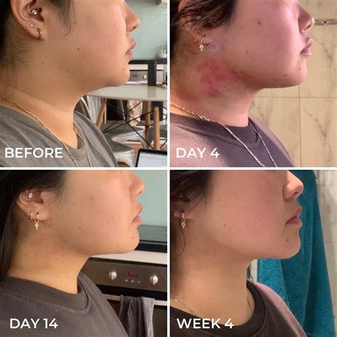 Chin And Neck Lipo Recovery at Amparo Lisi blog