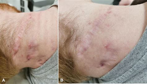 Effects of mixed-technology CO2 and Ga-As laser in patients with ...