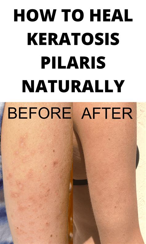 How To Treat Keratosis Pilaris On The Face at Rita Skelley blog