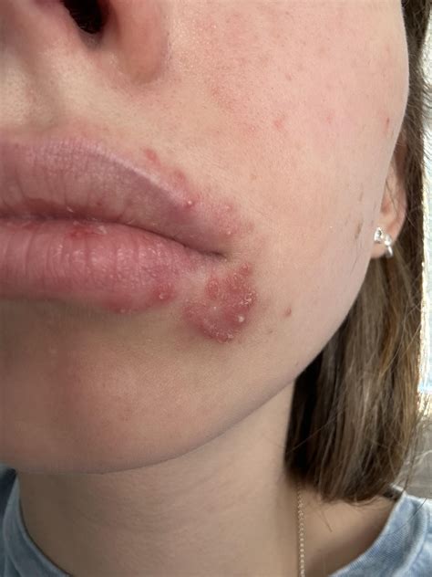 persistent acne around mouth : r/DermatologyQuestions