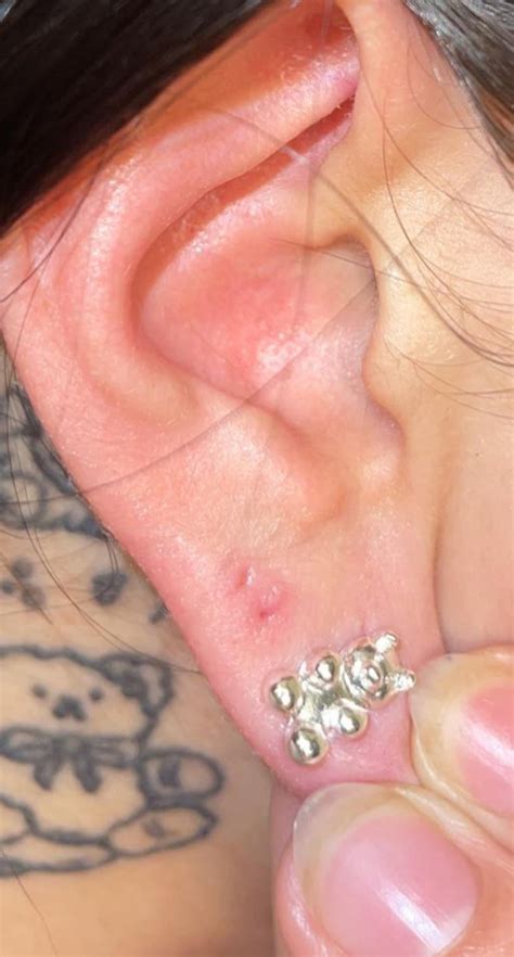 A third hole ‘formed’ on my ear. It goes straight through like a piercing but I’ve only ever had ...