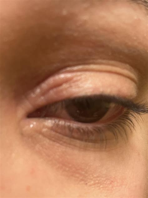 Eyelid eczema getting worse with the weather. Gets so dry the skin ...