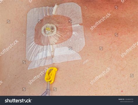 3 Portacath Images, Stock Photos & Vectors | Shutterstock