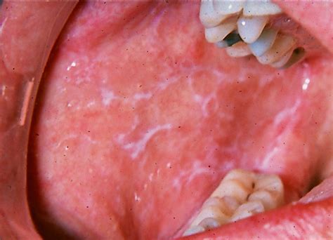 Clinical presentation of OLP showing Wickham's Striae