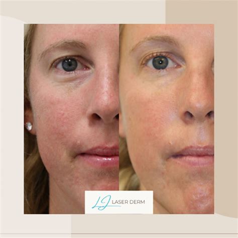 Rosacea - La Jolla Dermatology