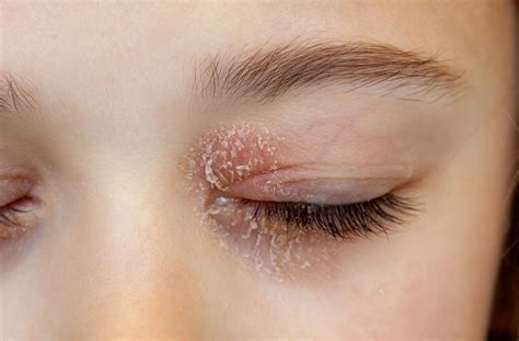 Is Blepharitis Contagious? | Great Hills Eye Care | Texas