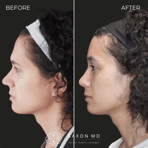 Best 12 Facial Feminization Surgery Before And After Photos – Artofit