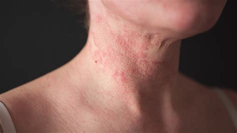 How Cooling Helps Reduce Skin Irritation in Eczema Patients