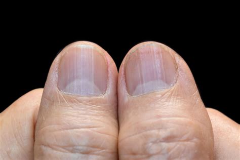 Raised Bumps On Fingernails