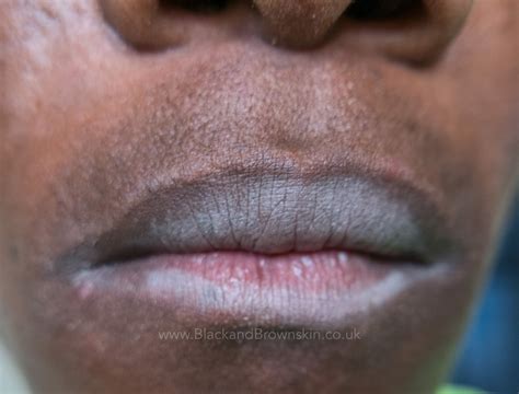 Lip Licker's Dermatitis — Black & brown skin