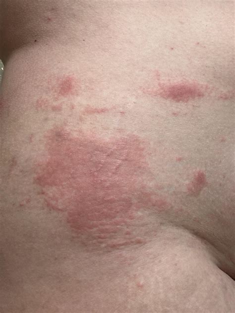 Chronic hives? : r/urticaria