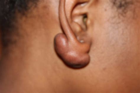 Keloid Scar Removal - Dr.Derme Skin Clinics
