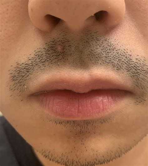 Wax Bumps On Upper Lip at Ben Morrow blog