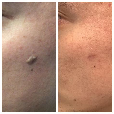 Glycolic Acid Peel Seborrheic Keratosis at Helen Rooker blog
