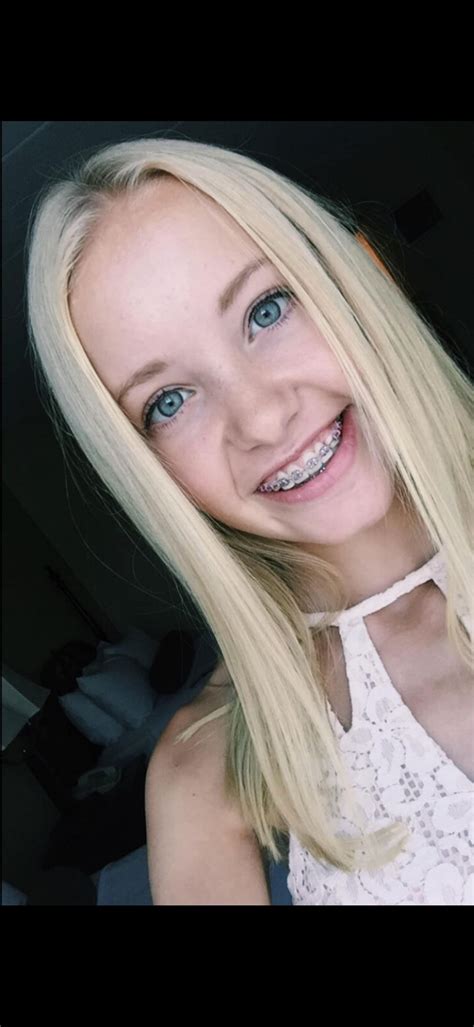 🫶🏻🫶🏻😼 : r/Amature_Braces