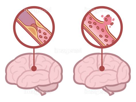 【脳梗塞 脳出血】の画像素材(41418936) | イラスト素材ならイメージナビ