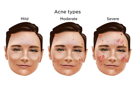 Moderate Acne | My Doctor Online