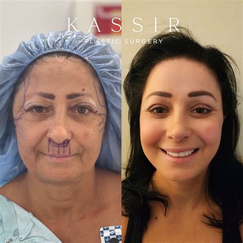 Cost Of Face Plastic Surgery