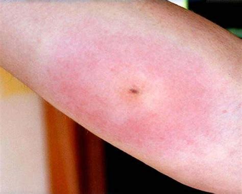 Picaduras De Insecto Infectadas: ¿Cómo Identificarlas Y Tratarlas ...