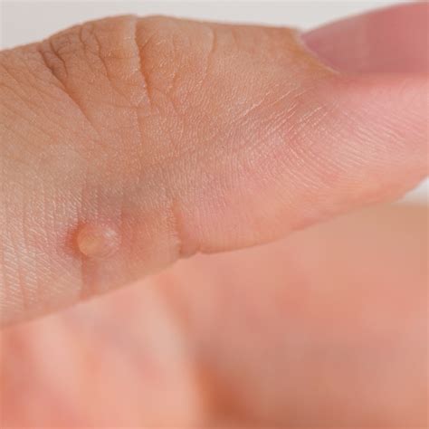 Flat Warts On Hands