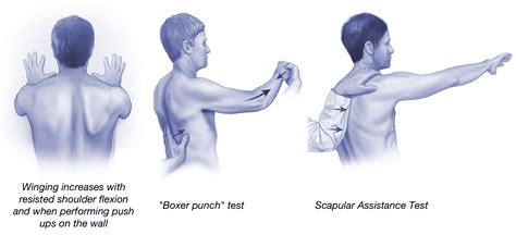 Serratus Anterior Weakness: One of Many Reasons for Shoulder Blade ...