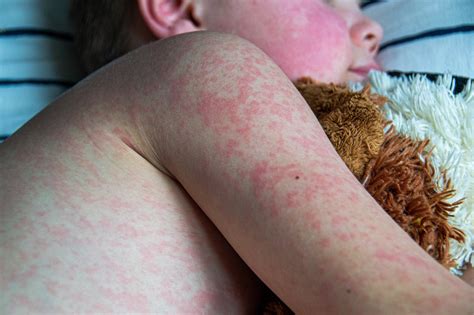 U.S. Measles Cases Surpass 2023 Levels, C.D.C. Says - The New York Times