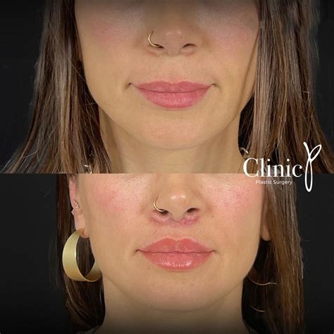 Lip Lift – Clinic P | Aesthetic Surgery Turkey