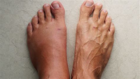 Edema In Feet