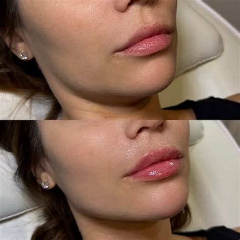 Lip Flip Before and After - Before After Journey