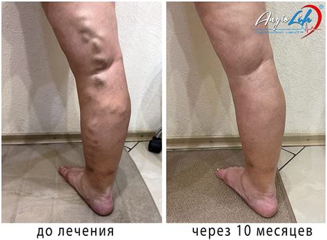 Ефективне лікування варикозу лазером в Києві та Запоріжжі