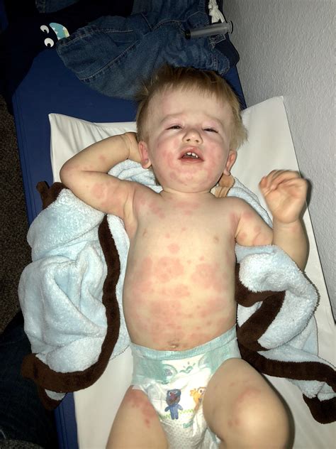 Amoxicillin Rash Baby
