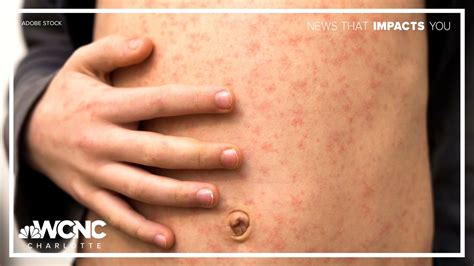New measles case confirmed in western North Carolina | wcnc.com