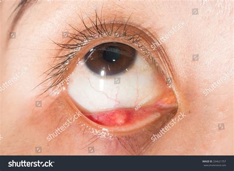 Meibomian Gland Cyst