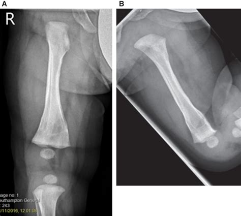 Definition Of Bucket Handle Fracture at Terri Greaves blog