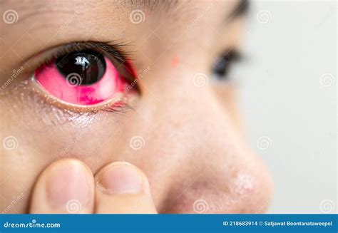 Subconjunctival Hemorrhage Newborn
