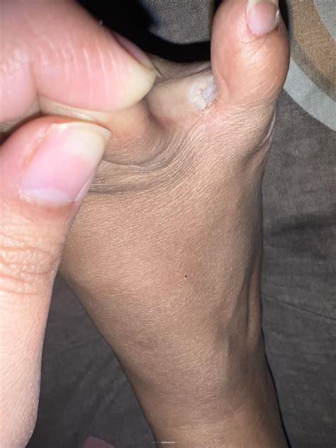 Ask a Dermatologist Online for Skin Peeling Between Pinky Toe